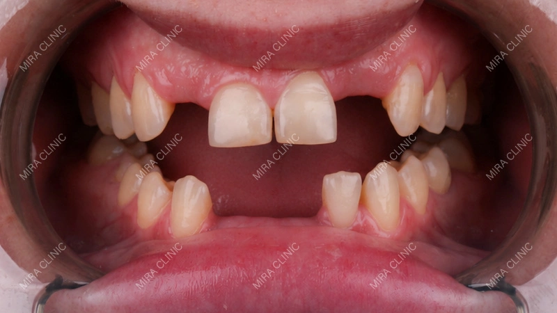 I Have 4 Missing Teeth — What Implant Option Do I Need?